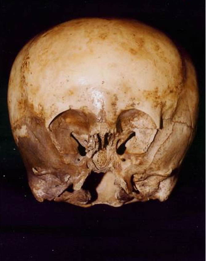 The Starchild skull was